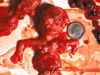 /album/okrucie%c5%84stwo%20aborcji/aborcja-02-jpg/